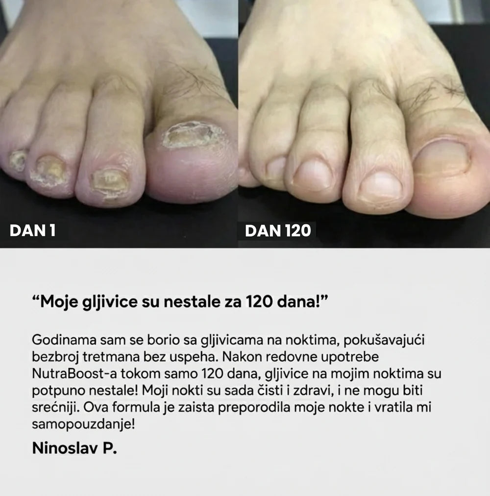 Apiderma — 100% Prirodni Melem za Gljivice | Moćna Pčelinja Formula koja Eliminiše Gljivice Na Dodir