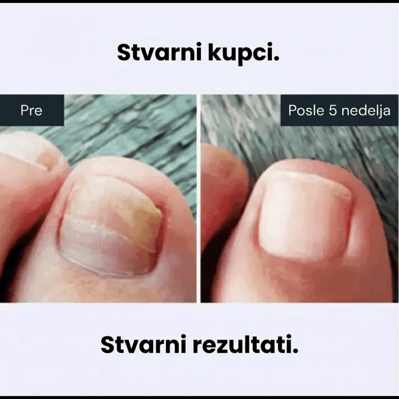 Apiderma — 100% Prirodni Melem za Gljivice | Moćna Pčelinja Formula koja Eliminiše Gljivice Na Dodir