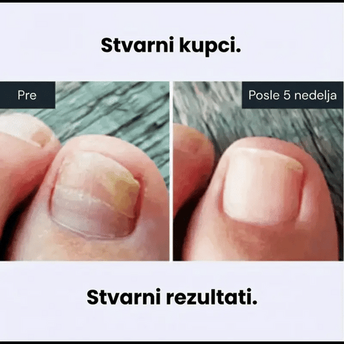Apiderma — 100% Prirodni Melem za Gljivice | Moćna Pčelinja Formula koja Eliminiše Gljivice Na Dodir