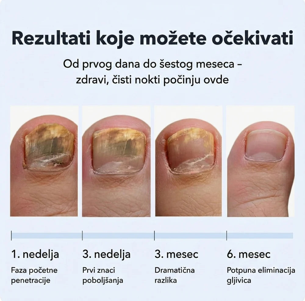 Apiderma — 100% Prirodni Melem za Gljivice | Moćna Pčelinja Formula koja Eliminiše Gljivice Na Dodir
